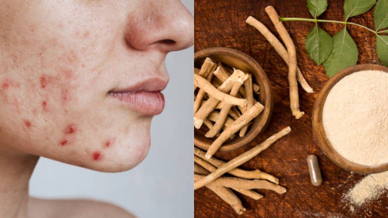 Ashwagandha for Skin: তাপমাত্রা বাড়তেই মুখ ভরেছে ব্রণতে? এই আয়ুর্বেদিক উপাদান ১ বার মাখলেই কমবে ত্বকের সমস্যা