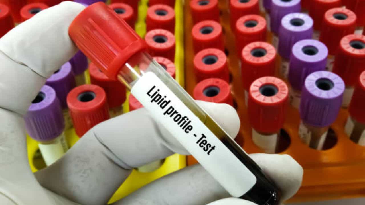 Cholesterol Test: ঘরে বসেই এভাবে কোলেস্টেরল টেস্ট করুন, ফল 100 mg/dl পেরোলেই ডাক্তারের কাছে ছুটুন Cholesterol Test: ঘরে বসেই এভাবে কোলেস্টেরল টেস্ট করুন, ফল 100 mg/dl পেরোলেই ডাক্তারের কাছে ছুটুন