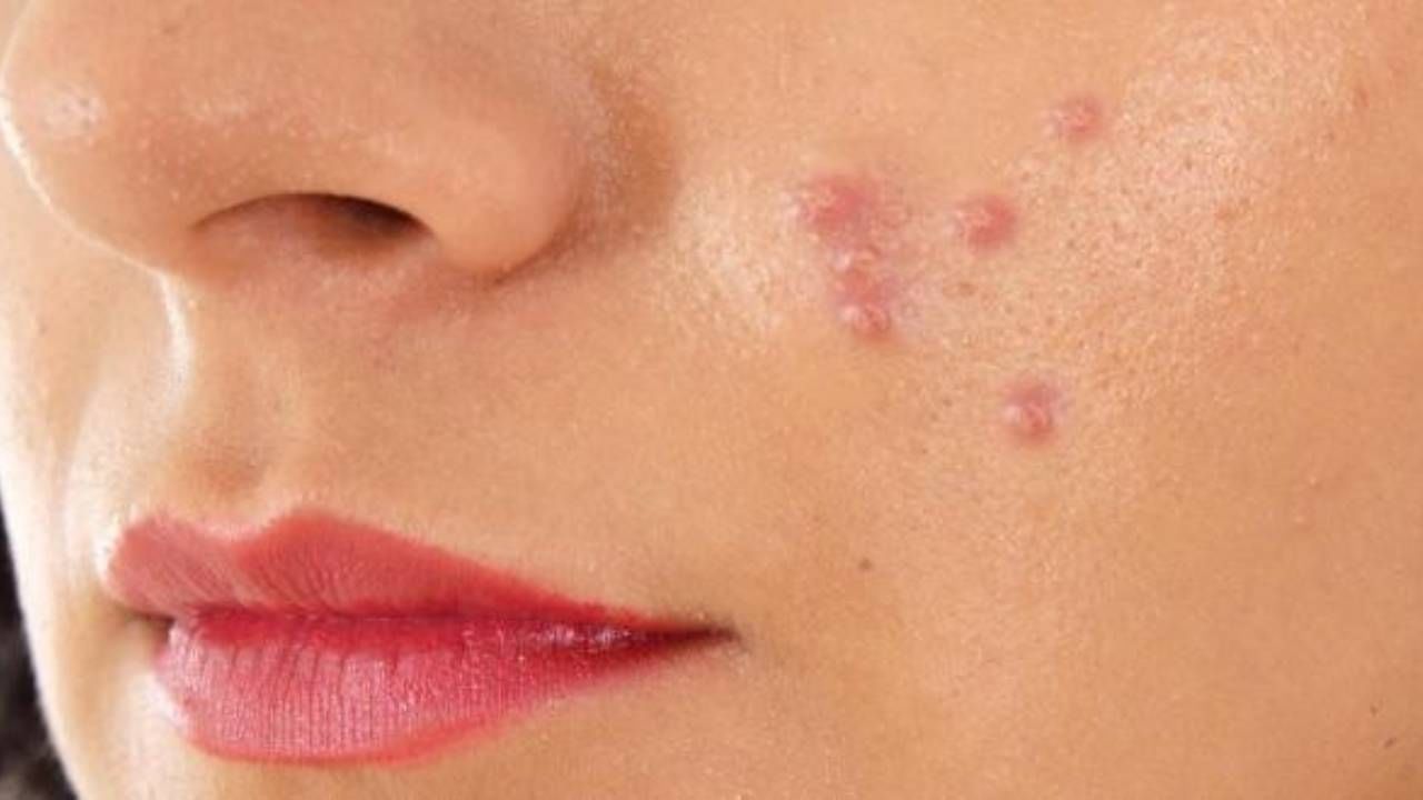 ব্রণের উৎপাত থেকে নিস্তার পাওয়া মোটেই সহজ কাজ নয়। প্রাচীন ভারতীয় আয়ুর্বেদে ব্রণ সারানোর একাধিক উপায় বলা আছে।