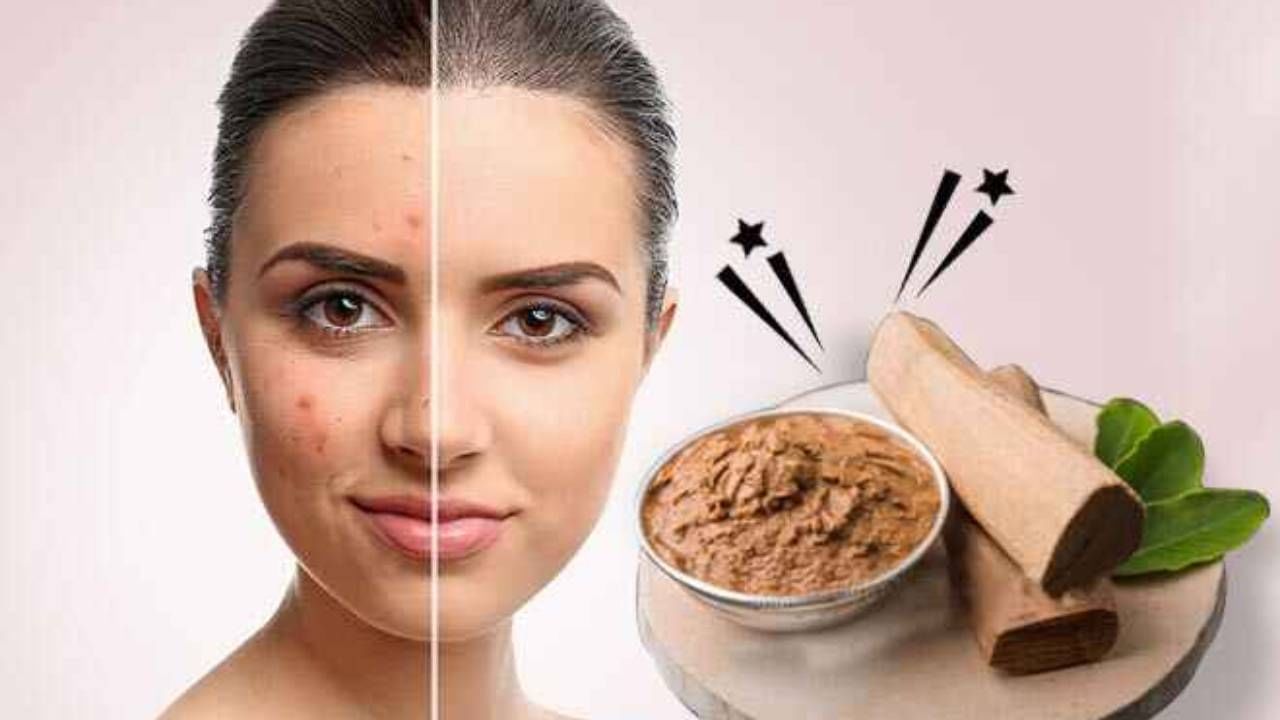 আয়ুর্বেদে প্রদাহ, ব্যথা, কাটাছেঁড়া কমাতে চন্দন ব্যাপকভাবে ব্যবহার করা হয়। গোলাপজলে বা সাধারণ জলে চন্দনগুঁড়ো গুলে ঘন পেস্টের মতো তৈরি করে তা ব্রণর উপরে লাগিয়ে রাখুন। সঙ্গে সঙ্গে শীতলতার অনুভূতি হবে। এরপর শুকোতে দিন। শুকিয়ে টান ধরলে জলে ধুয়ে ফেলুন।