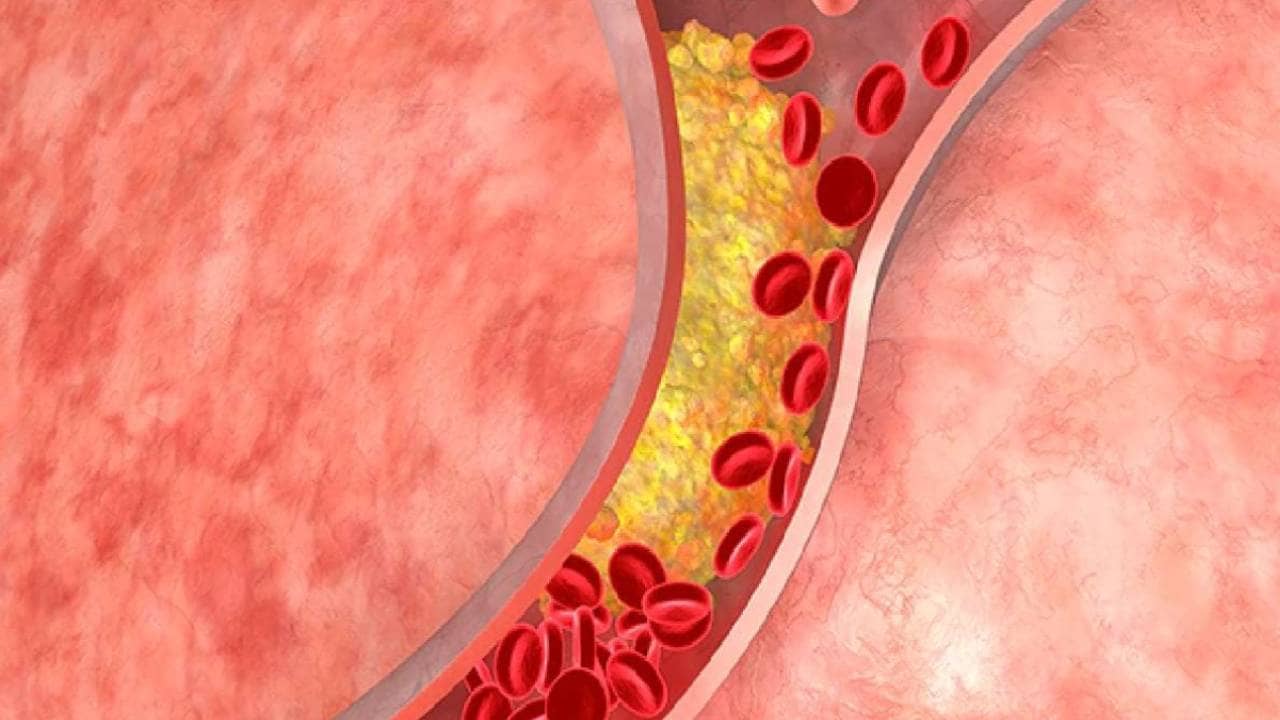 Bad Cholesterol: খারাপ কোলেস্টেরলকে শরীর থেকে খেদিয়ে তাড়াবে রান্নার এই উপাদান