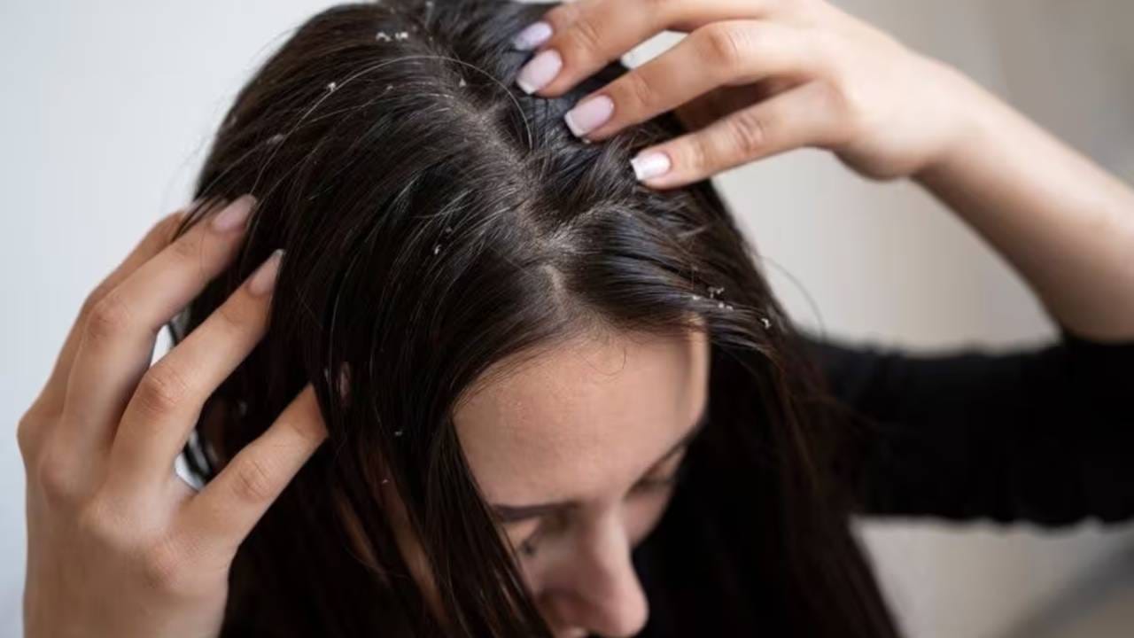 Dandruff ড্যানড্রাফের সমস্যায় নাজেহাল? এই ঘরোয়া উপাদান চুলে লাগালেই