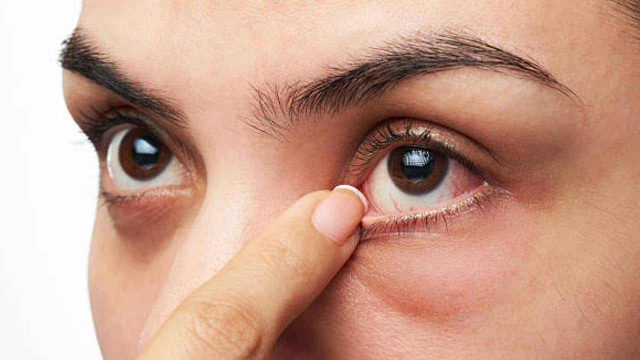 Dry Eyes Syndrome: প্রচণ্ড গরমে ড্রাই আই সিনড্রোমের সমস্যা হচ্ছে, এই রোগের উপসর্গ ও প্রতিকার কী?