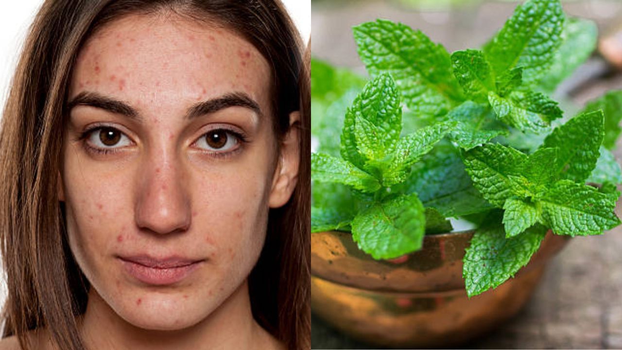 Mint for Acne ব্রণতে মুখ পুড়ছে? এই পাতা বেটে মাখলেই ফিরবে ত্বকের হাল