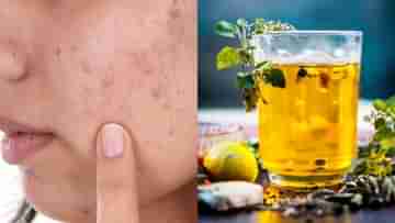 Acne cure drinks: ক্রিম না লাগিয়ে এই পানীয় খান, রাতারাতি কমবে ব্রণ আর পাবেন ফর্সা ত্বক