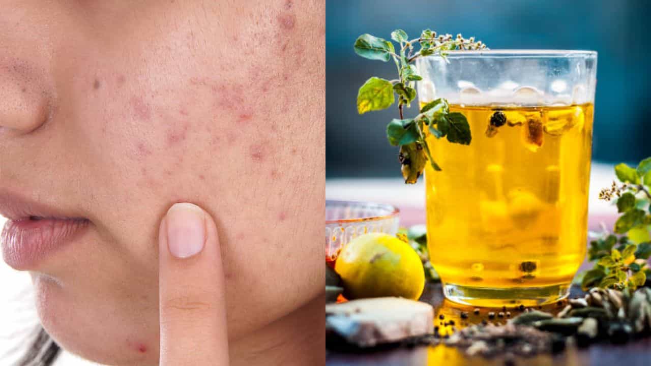 Acne cure drinks: ক্রিম না লাগিয়ে এই পানীয় খান, রাতারাতি কমবে ব্রণ আর পাবেন ফর্সা ত্বক Acne cure drinks: ক্রিম না লাগিয়ে এই পানীয় খান, রাতারাতি কমবে ব্রণ আর পাবেন ফর্সা ত্বক