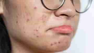 Acne prone Skin: আয়নার সামনে দাঁড়ালে মন খারাপ হয়ে যায়? এই ৪ টিপস মানলে কমবে ব্রণ হওয়ার প্রবণতা