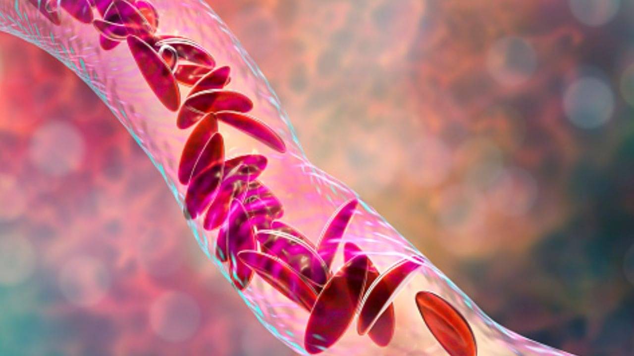 Sickle Cell Anemia: হাত-পা ফুলে যাওয়া এই ভয়ঙ্কর রোগের কারণ হতে পারে, কীভাবে বুঝবেন?