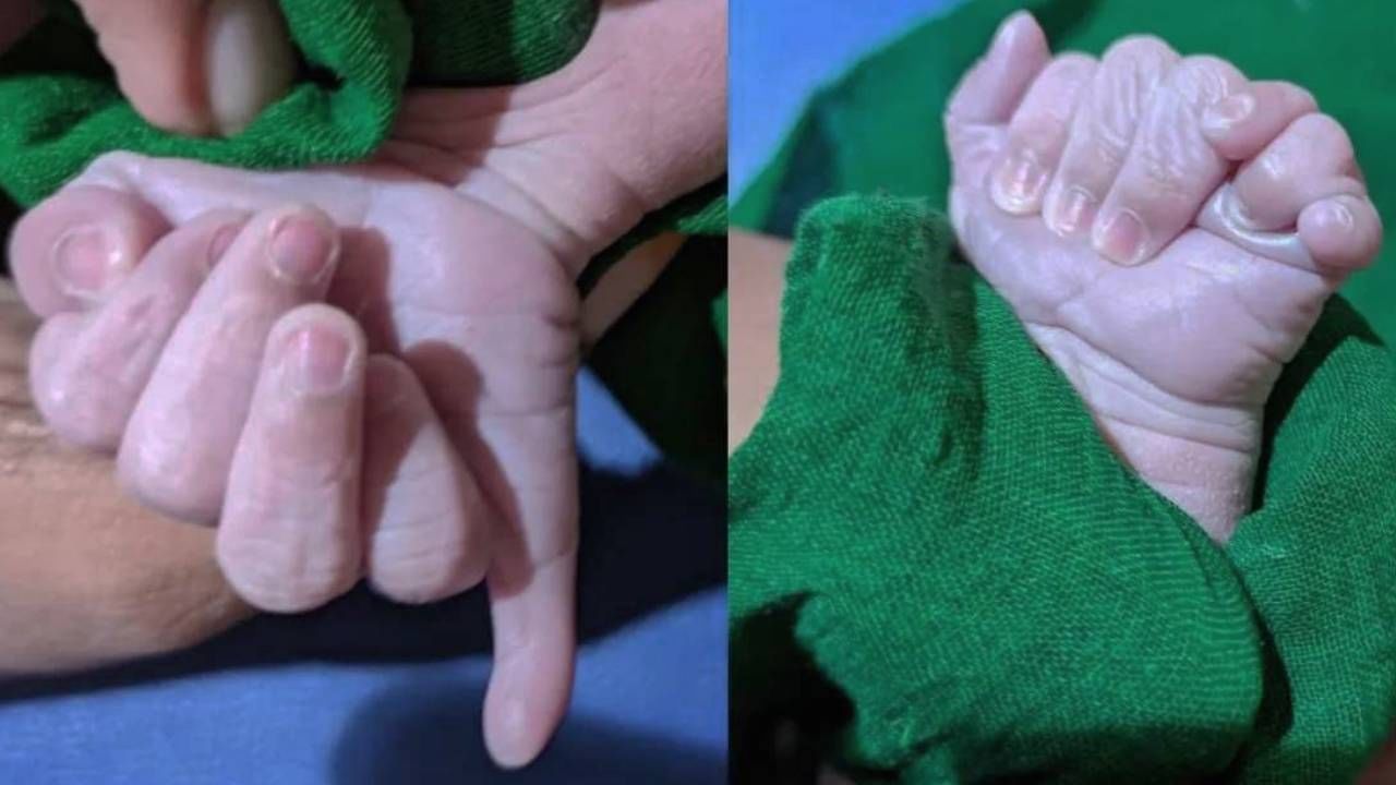 Child with 25 Fingers: ২৫টি আঙুল নিয়ে জন্ম শিশুর; ঈশ্বরের আশীর্বাদ বলছে পরিবার Child with 25 Fingers: ২৫টি আঙুল নিয়ে জন্ম শিশুর; ঈশ্বরের আশীর্বাদ বলছে পরিবার