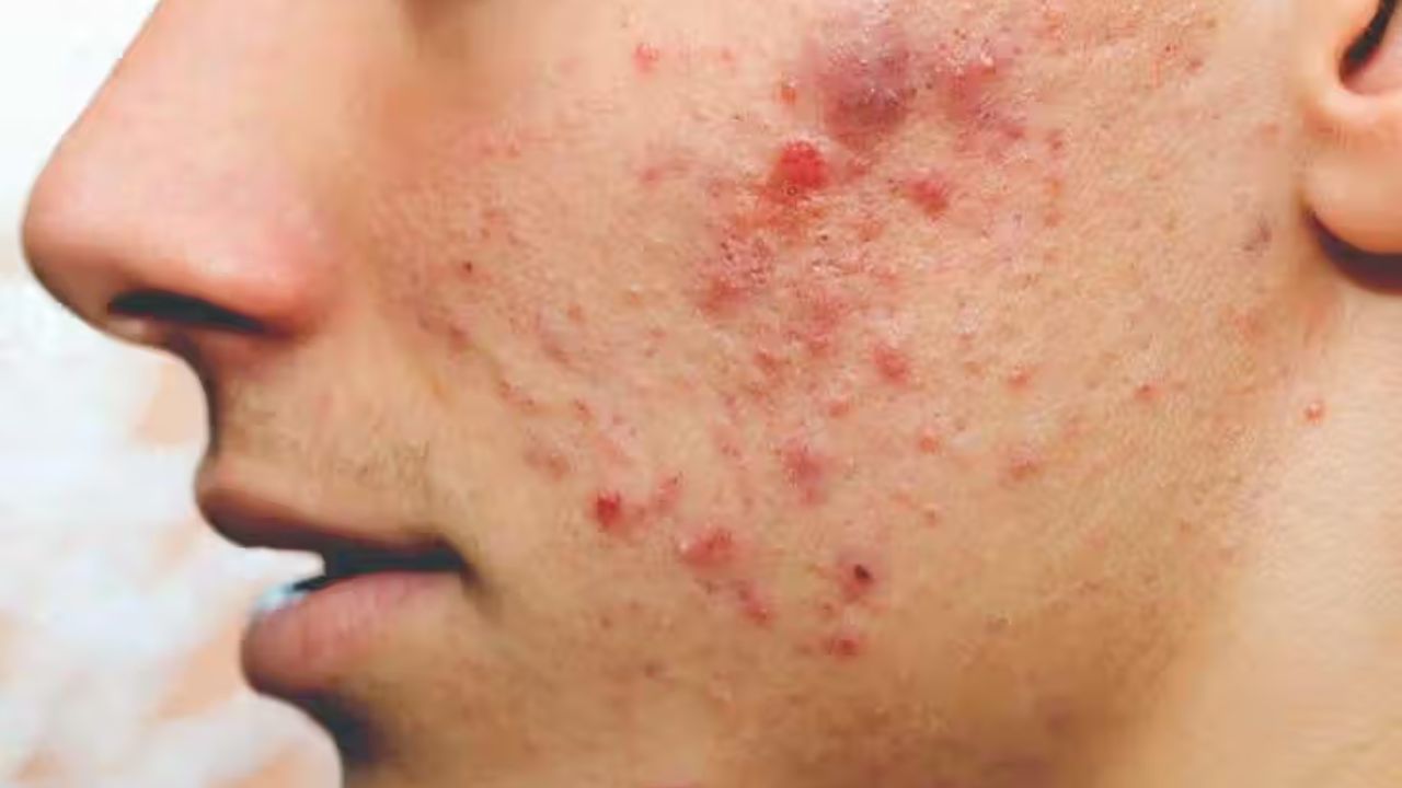 Pimples: ব্রণের সমস্যায় জেরবার? ৪ অভ্যাস পরিবর্তনে হতে পারে মুশকিল আসান