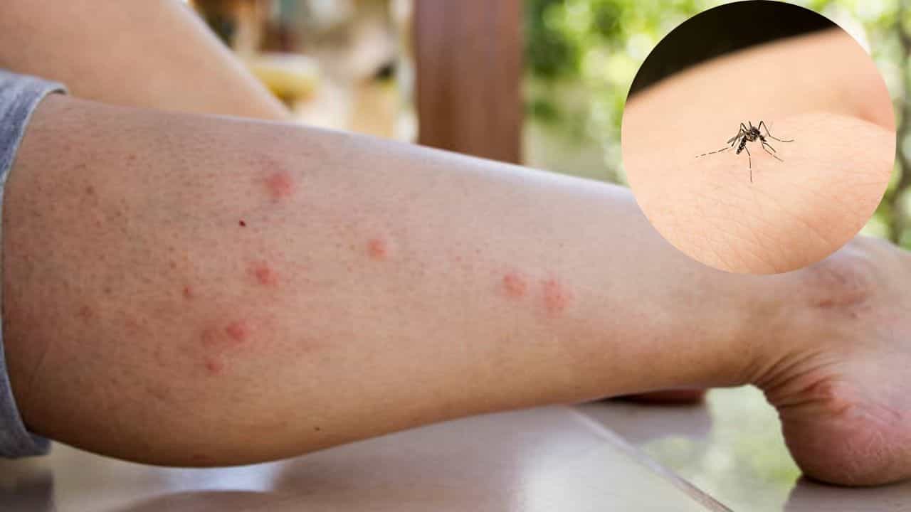 Mosquito Bites: মশা কামড়ে পা ফুলিয়ে দিয়েছে? এই টোটকা কাজে লাগান সেকেন্ডের মধ্যে কমবে চুলকানি Mosquito Bites: মশা কামড়ে পা ফুলিয়ে দিয়েছে? এই টোটকা কাজে লাগান সেকেন্ডের মধ্যে কমবে চুলকানি