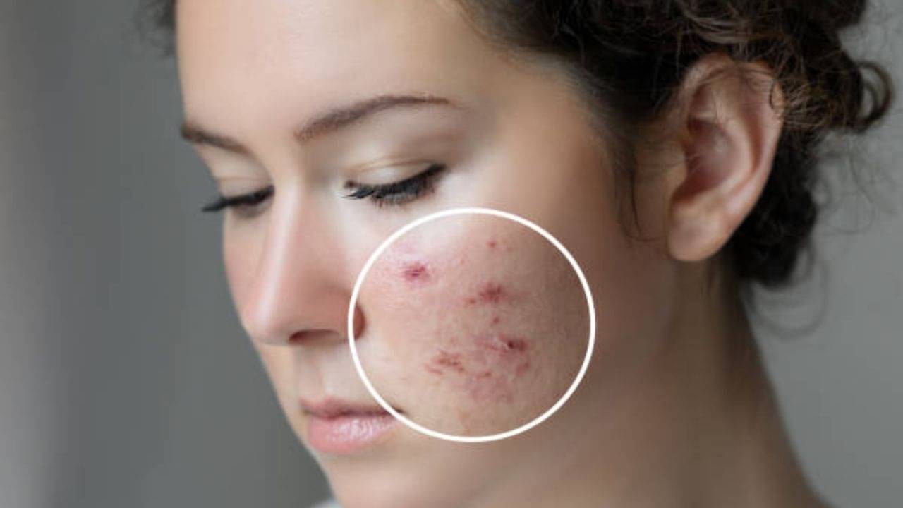Home made Facewash: বর্ষায় ব্রণ-পিম্পলস বাড়ছে? বাড়িতে এভাবে ফেসওয়াশ তৈরি করে মুখে লাগান