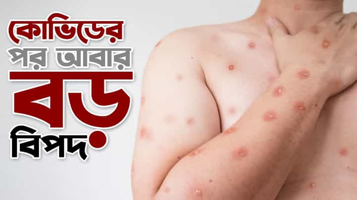 Mpox Outbreak: কোভিডের পর আজ আবার গ্লোবাল এমার্জেন্সি ঘোষণা করল WHO Mpox Outbreak: কোভিডের পর আজ আবার গ্লোবাল এমার্জেন্সি ঘোষণা করল WHO