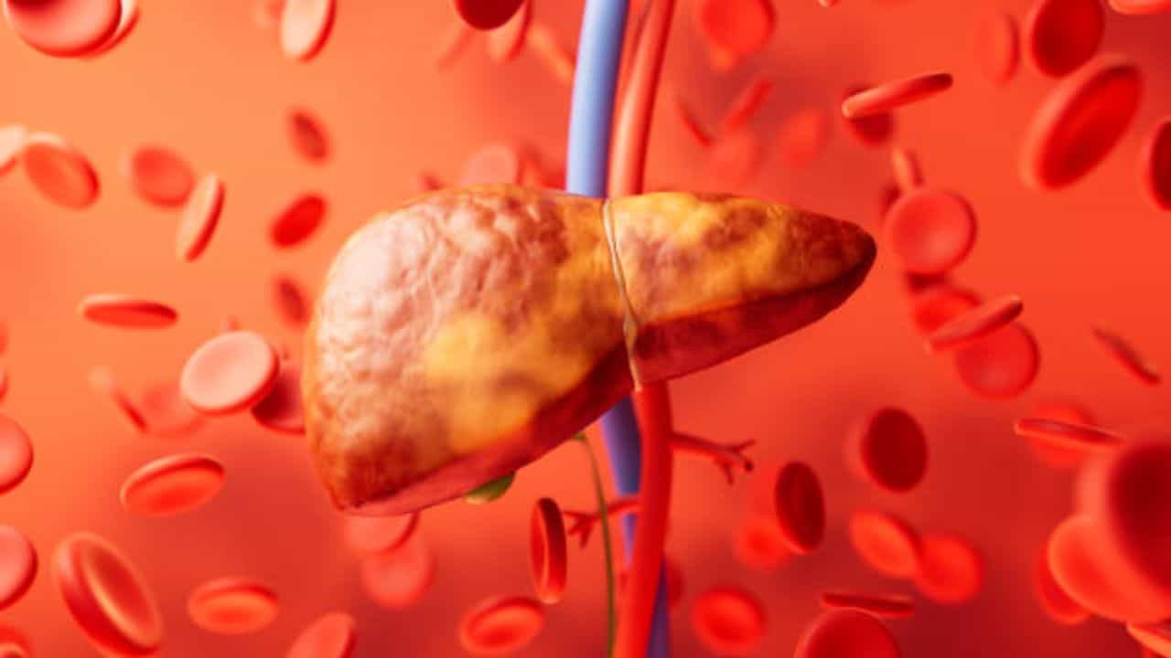 Fatty Liver: কোলেস্টেরল বেশি, ফ্যাটি লিভার ধরা পড়েছে? এই ৫ খাবার খেলেই চাঙ্গা থাকবেন Fatty Liver: কোলেস্টেরল বেশি, ফ্যাটি লিভার ধরা পড়েছে? এই ৫ খাবার খেলেই চাঙ্গা থাকবেন