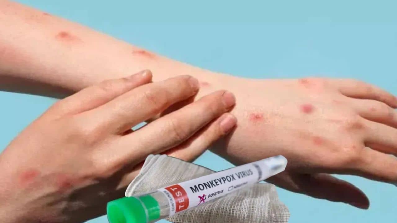 Monkeypox case in India: ভারতে দ্বিতীয় মাঙ্কিপক্স আক্রান্তের খোঁজ, এবার কেরলের যুবক