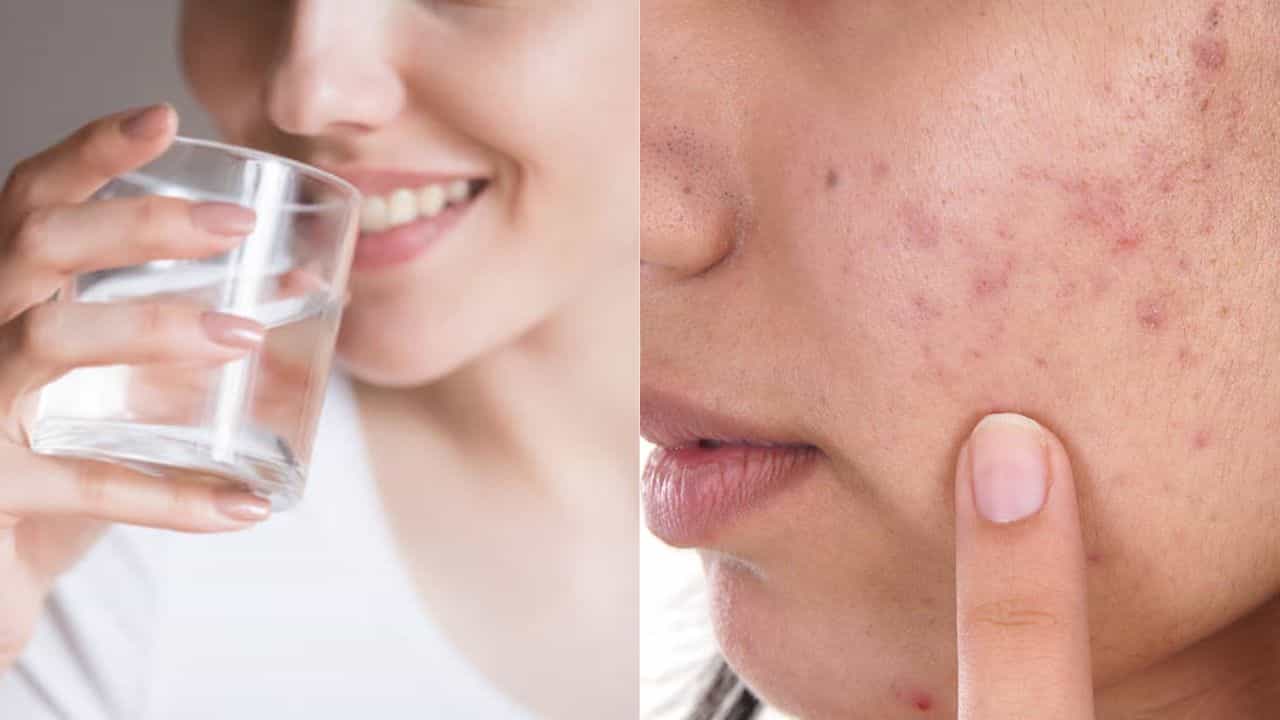 Skin Hydration: ব্রণ নিয়ে বিরক্ত? শুধু জল খেয়েই তাড়ান ত্বকের এই সমস্যা Skin Hydration: ব্রণ নিয়ে বিরক্ত? শুধু জল খেয়েই তাড়ান ত্বকের এই সমস্যা