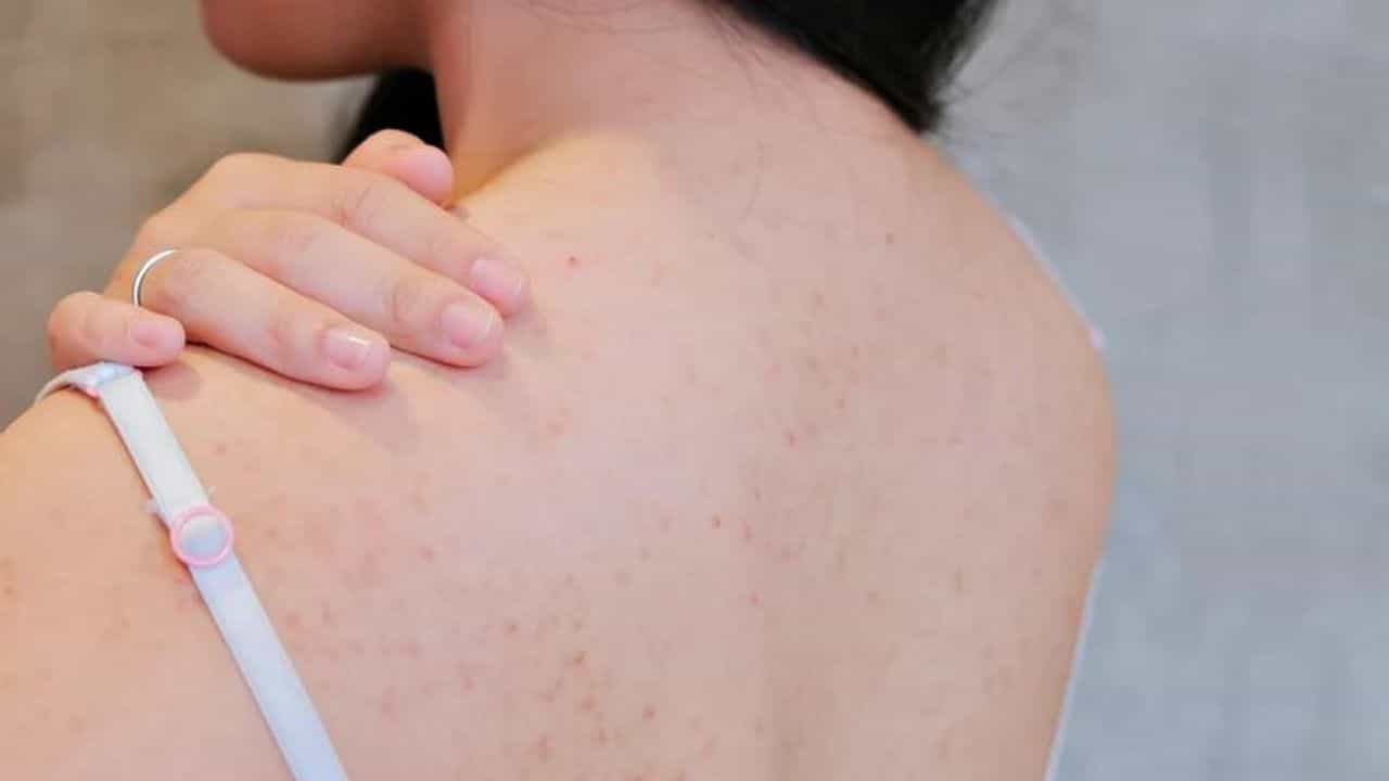 Acne: পিঠ ভরে গিয়েছে ব্রণতে? খরচ না করেই ঘরোয়া উপকারে মিলবে মুক্তি! Acne: পিঠ ভরে গিয়েছে ব্রণতে? খরচ না করেই ঘরোয়া উপকারে মিলবে মুক্তি!