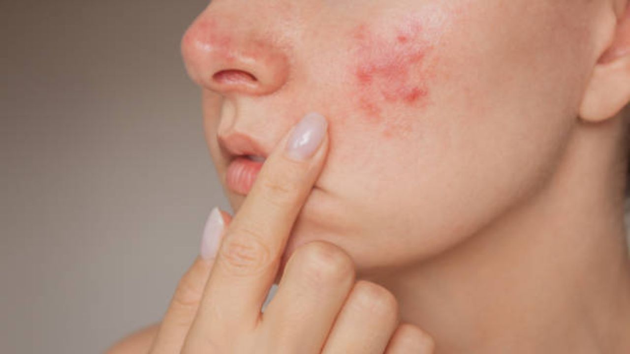 Acne Remedies: পুজোর এই কাজগুলো করলে ব্রণ উধাও হবে মাত্র ৭ দিনে, বাড়বে ত্বকের জেল্লাও