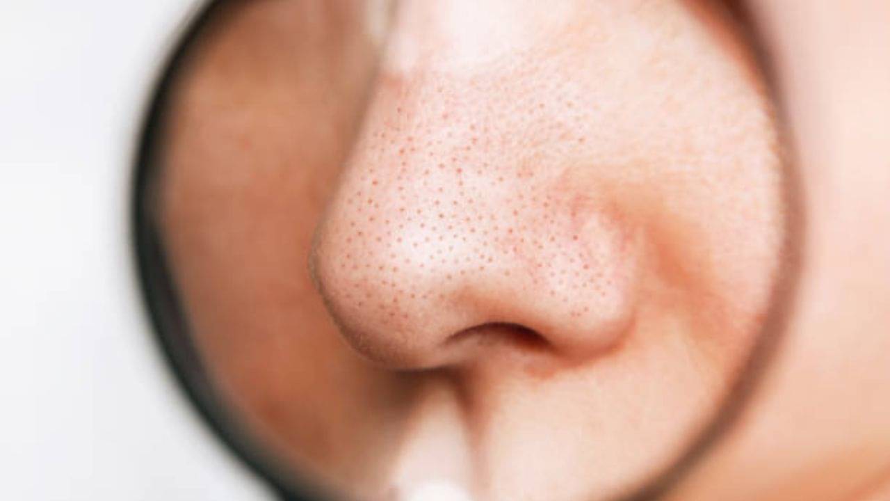 Blackheads Remove: নাকের পাশে, থুতনিতে ব্ল্যাকহেডস ভর্তি? এই সহজ টোটকায় মিলবে মসৃণ ত্বক