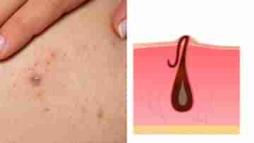 Ingrown Hair: চামড়ার ভিতরে রোম বেড়ে চলেছে? ইনগ্রো হেয়ারের সমাধানে কী স্ক্রাব ব্যবহার করবেন?