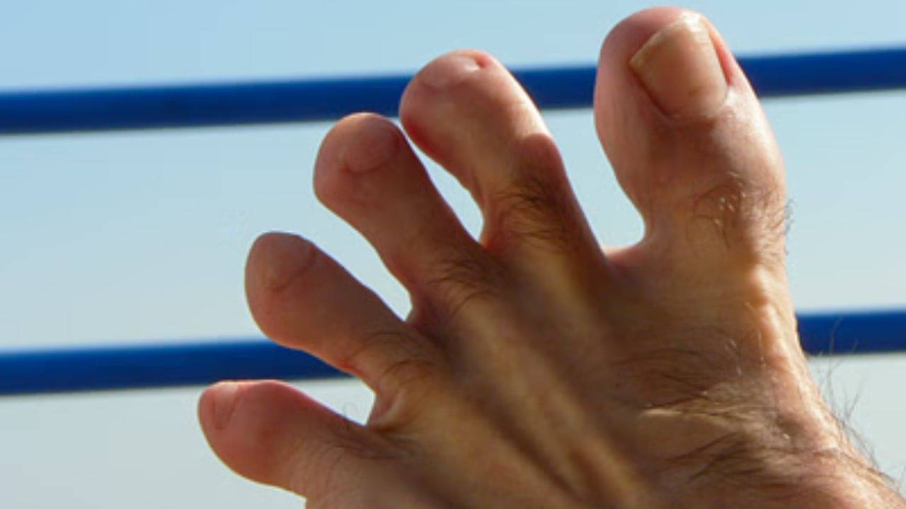 Toenail Fungus: পায়ের নখে পুঁজ জমে হলুদ হয়ে গিয়েছে? ঘরোয়া টোটকাতেই হবে সমাধান