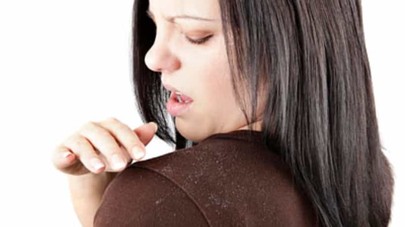 Anti Dandruff Tips: শীত পড়তেই খুশকির সমস্যায় জেরবার? এই তিনের মিশ্রণে ৩ সপ্তাহে হবেন সমস্যা মুক্ত