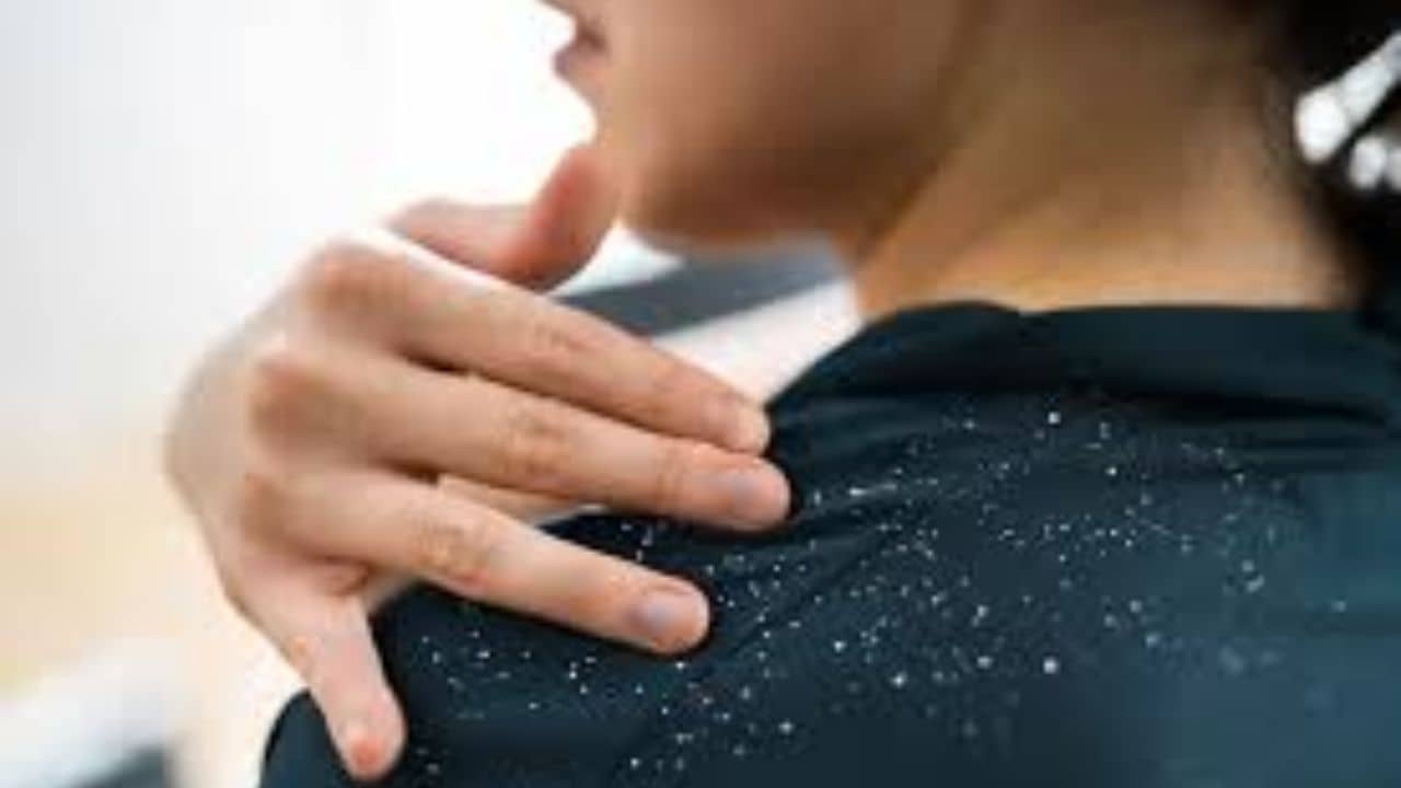 মাথা ঝাঁকালেই খুশকির বৃষ্টি? এই উপায়ে মাখুন তেল