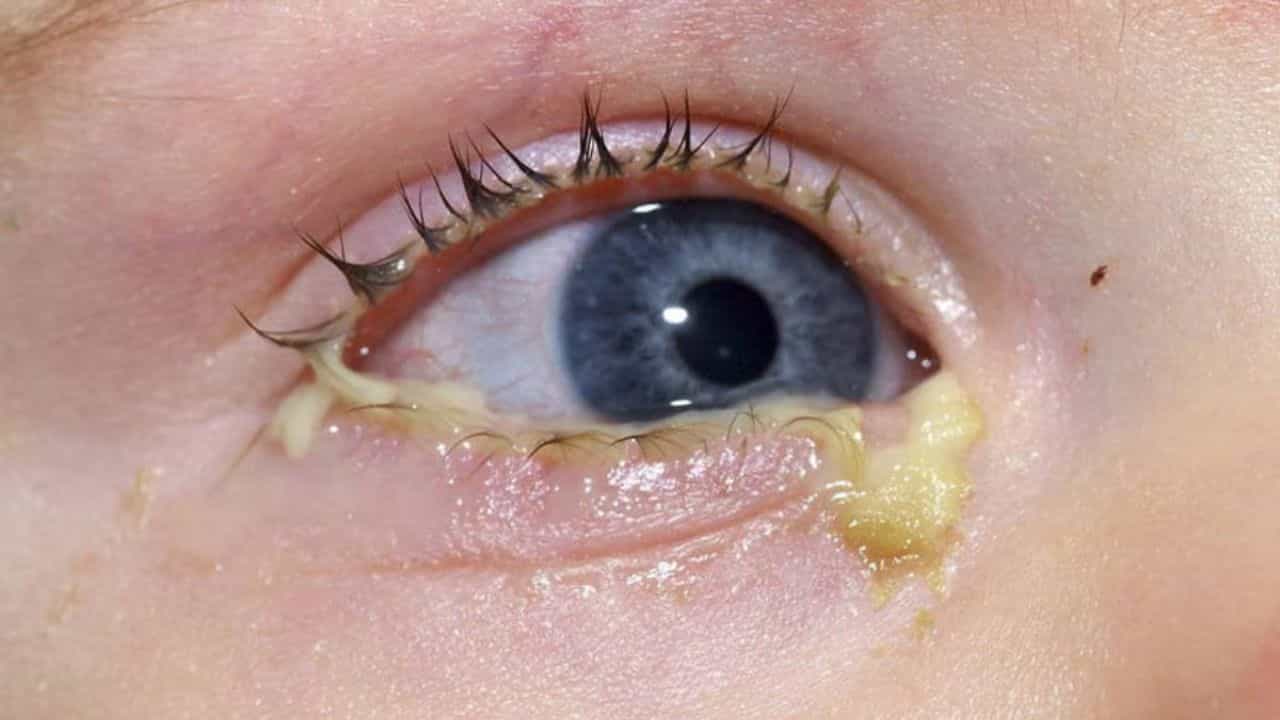 Eye Care Tips: সকালবেলা চোখের কোণে কেন পিচুটি জমে জানেন? Eye Care Tips: সকালবেলা চোখের কোণে কেন পিচুটি জমে জানেন?