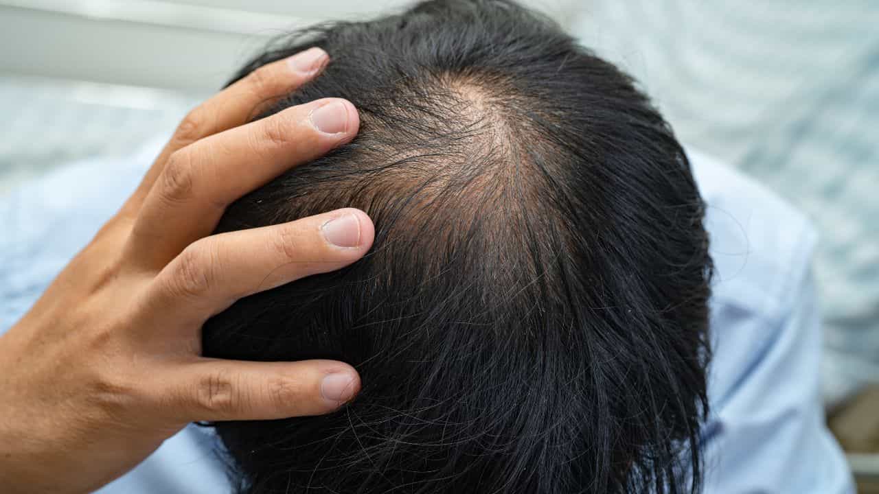 Hair Care Tips: টাক মাথায় গজাবে চুল, ঘরেই রয়েছে এর 'ওষুধ'! Hair Care Tips: টাক মাথায় গজাবে চুল, ঘরেই রয়েছে এর 'ওষুধ'!