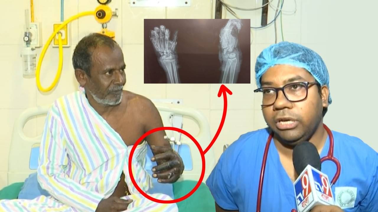 RG Kar Hospital: ফিরিয়েছে একের পর এক হাসপাতাল, কাটা কব্জি জোড়া লাগিয়ে তাক লাগাল আরজি কর, নেপথ্যে অনিকেতরা