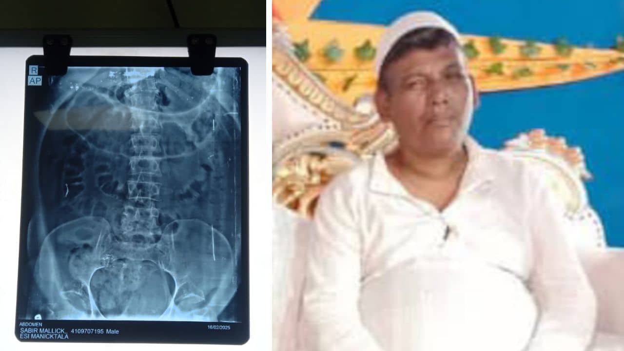 Uluberia: কর্মস্থলেই ইয়ার্কি মারতে গিয়ে পায়ুদ্বারে হাওয়া ঢুকিয়ে দিয়েছিল বন্ধু! প্রৌঢ়ের শরীরে যা পরিবর্তন হল, X-RAY রিপোর্ট দেখে শিউরে উঠছেন চিকিৎসকরাই