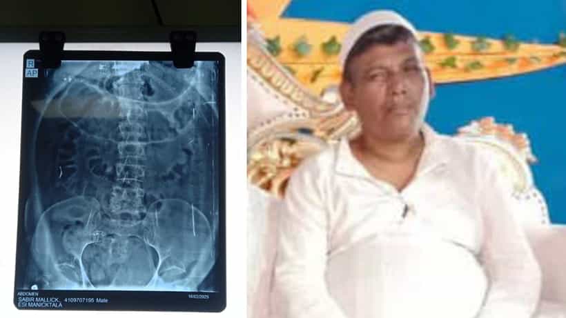 Uluberia: কর্মস্থলেই ইয়ার্কি মারতে গিয়ে পায়ুদ্বারে হাওয়া ঢুকিয়ে দিয়েছিল বন্ধু! প্রৌঢ়ের শরীরে যা পরিবর্তন হল, X-RAY রিপোর্ট দেখে শিউরে উঠছেন চিকিৎসকরাই