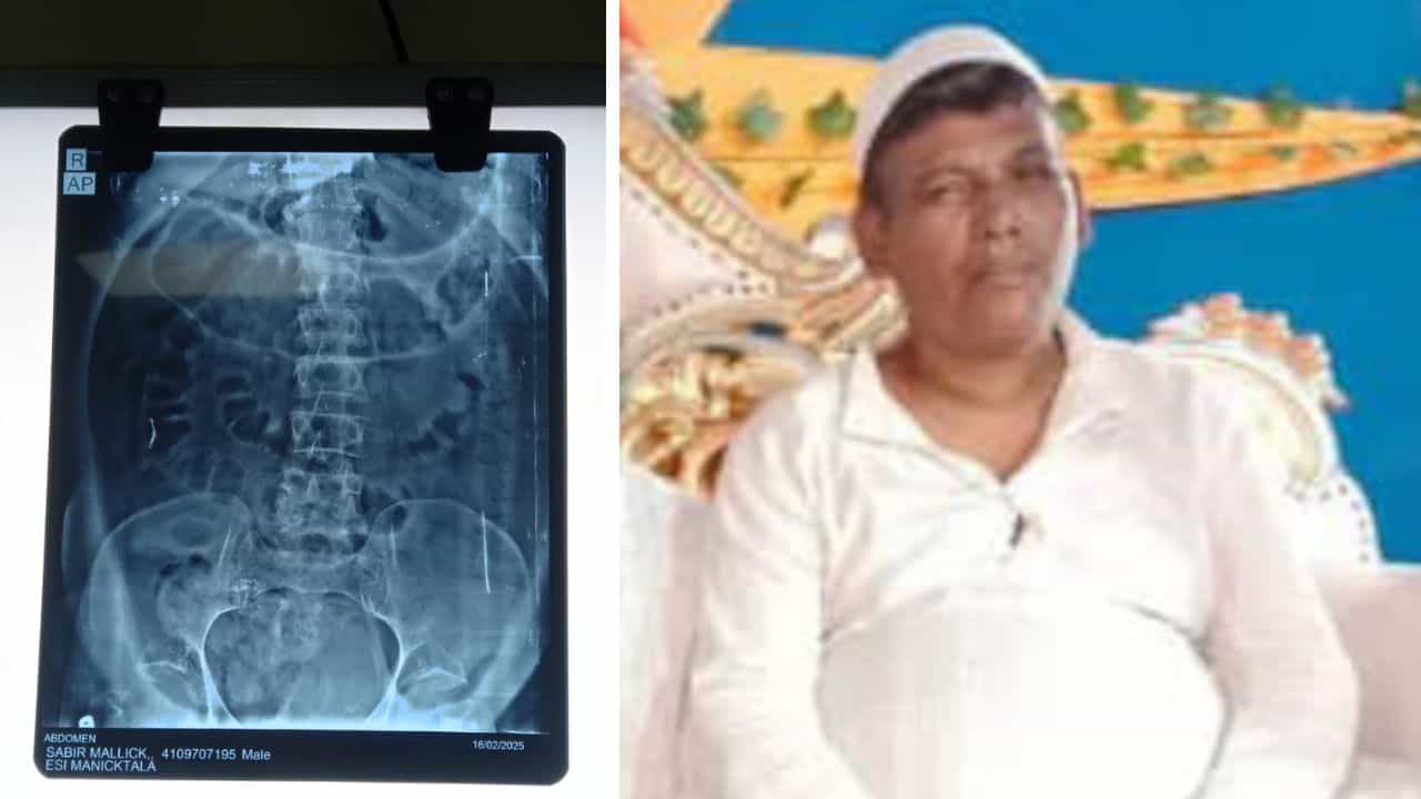 Uluberia: কর্মস্থলেই ইয়ার্কি মারতে গিয়ে পায়ুদ্বারে হাওয়া ঢুকিয়ে দিয়েছিল বন্ধু! প্রৌঢ়ের শরীরে যা পরিবর্তন হল, X-RAY রিপোর্ট দেখে শিউরে উঠছেন চিকিৎসকরাই Uluberia: কর্মস্থলেই ইয়ার্কি মারতে গিয়ে পায়ুদ্বারে হাওয়া ঢুকিয়ে দিয়েছিল বন্ধু! প্রৌঢ়ের শরীরে যা পরিবর্তন হল, X-RAY রিপোর্ট দেখে শিউরে উঠছেন চিকিৎসকরাই