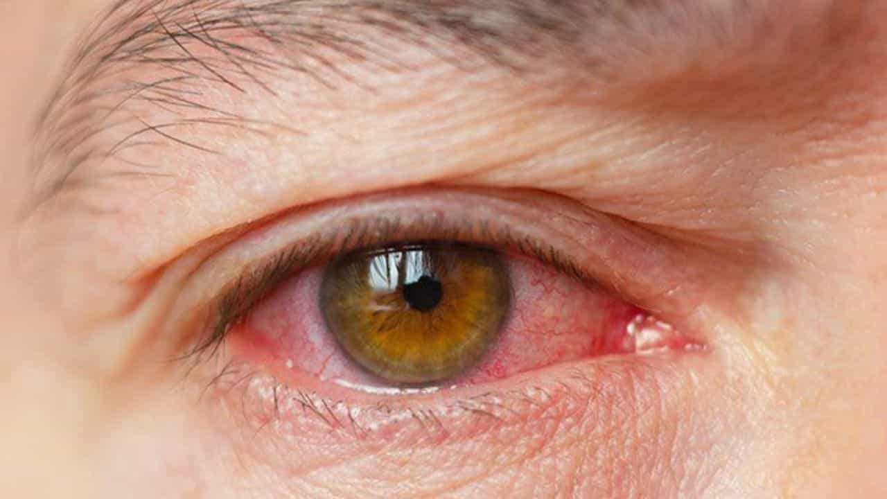 Dry Eyes: চোখের জল শুকিয়ে যাচ্ছে? ড্রাই আইয়ের সমস্যা থেকে মুক্তি পাবেন কী করে? Dry Eyes: চোখের জল শুকিয়ে যাচ্ছে? ড্রাই আইয়ের সমস্যা থেকে মুক্তি পাবেন কী করে?