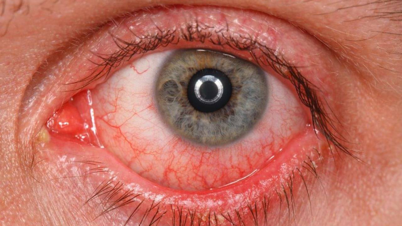 Eye Blood Pressure: অলক্ষে বাড়ছে না তো চোখের রক্তচাপ? কী ভাবে বুঝবেন?