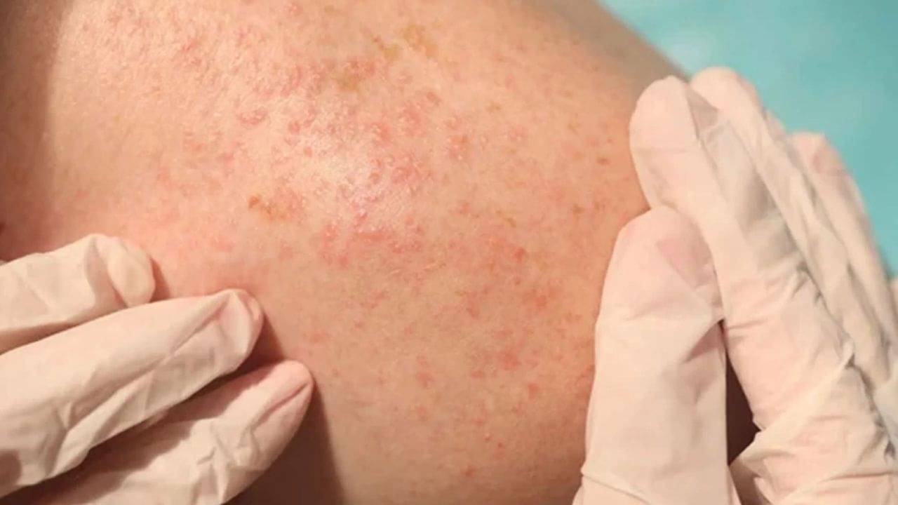 Summer Hacks: গরম পড়তে না পড়তেই ত্বকে অ্যালার্জি? কী ভাবে সুস্থ রাখবেন নিজেকে?