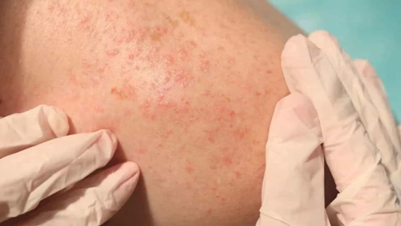 Summer Hacks: গরম পড়তে না পড়তেই ত্বকে অ্যালার্জি? কী ভাবে সুস্থ রাখবেন নিজেকে? Summer Hacks: গরম পড়তে না পড়তেই ত্বকে অ্যালার্জি? কী ভাবে সুস্থ রাখবেন নিজেকে?