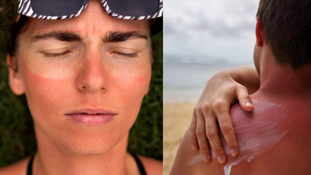 কড়া রোদ থেকে ফিরলেই ত্বকে জ্বালা? এবার ঘরোয়া উপায় পান স্বস্তি