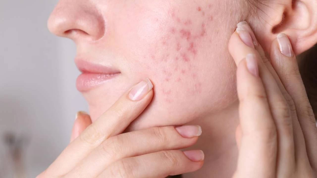 ব্রণ ও ব্রেকআউট থেকে মুক্তি পেতে চান, টানা ৭ দিন মেনে চলুন এই নিয়ম