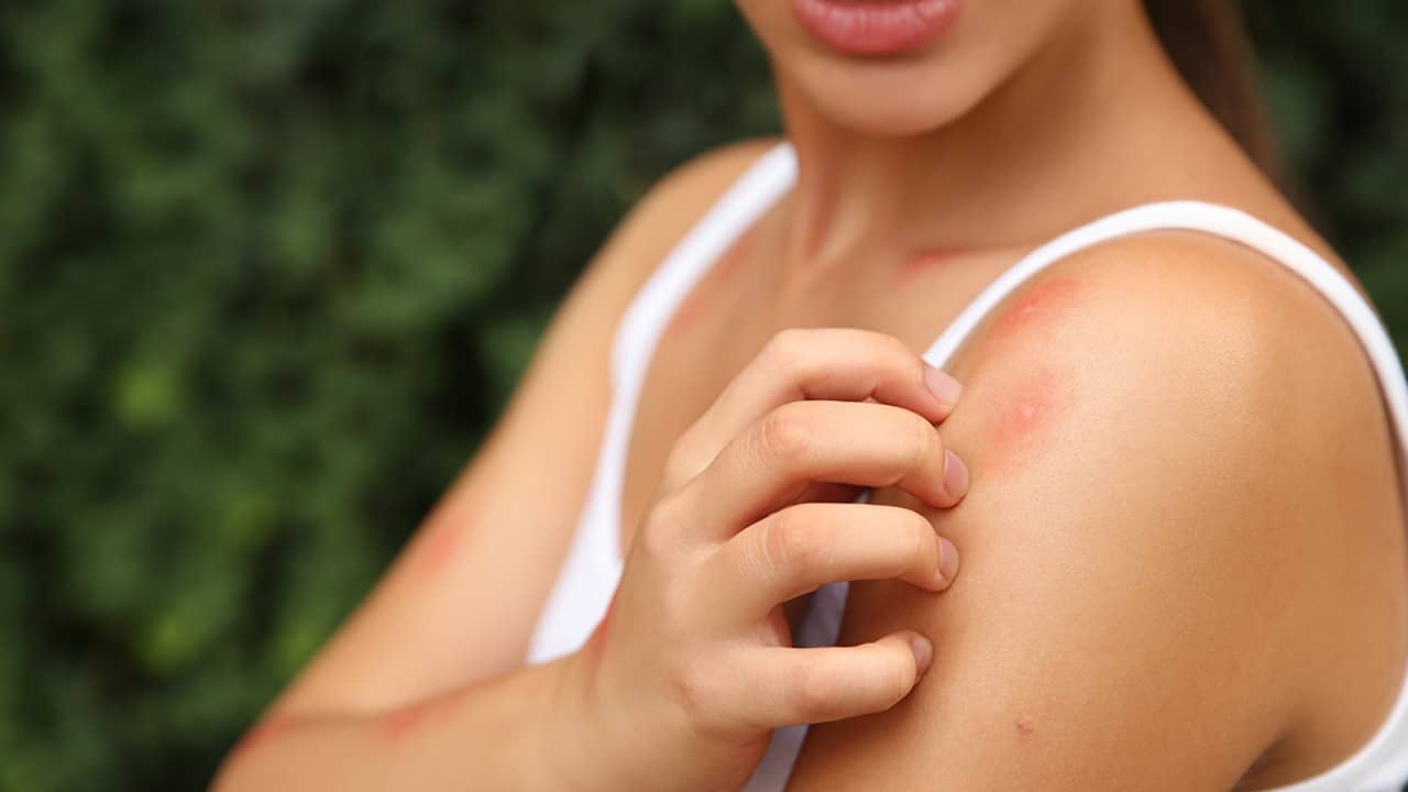 রোদে নাজেহাল? গরমে মুখের জ্বালাভাব কমানোর ঘরোয়া টিপস