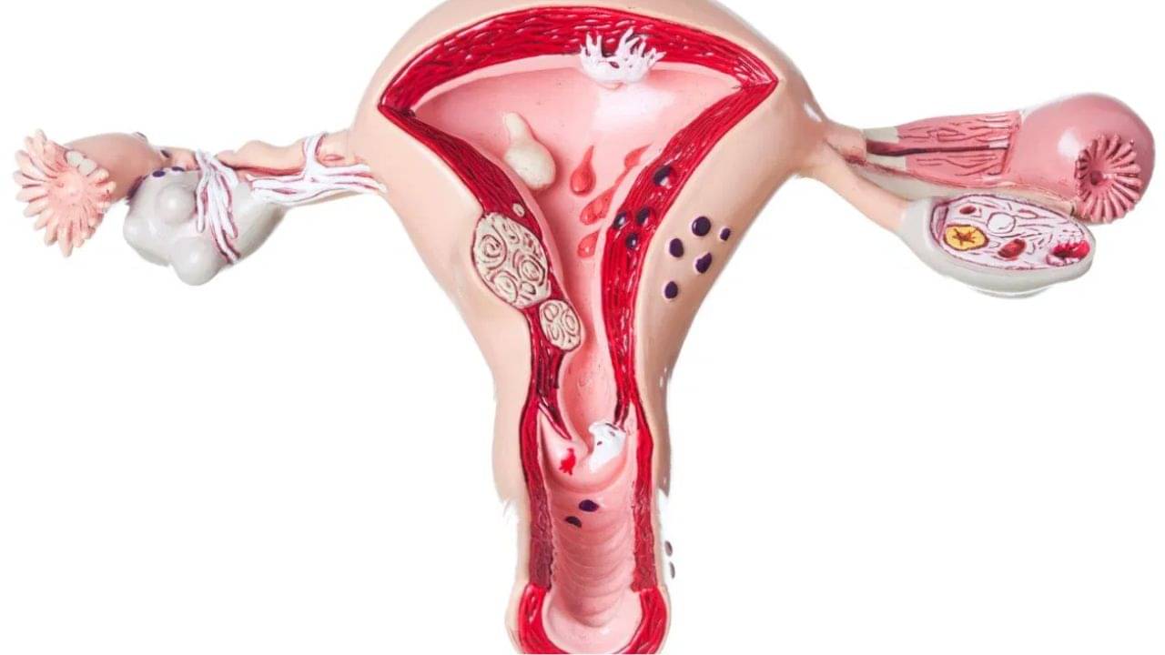 জরায়ুতে টিউমার মানেই কি ক্যানসার? ডাক্তার বলছেন...