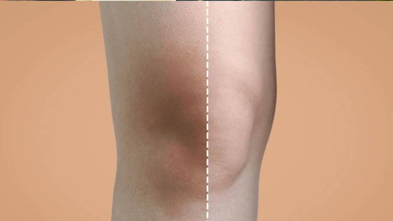 কালচে হাঁটু ও কনুই নিয়ে উদ্বেগ? এই ৭ টিপসেই দেখুন ম্যাজিক