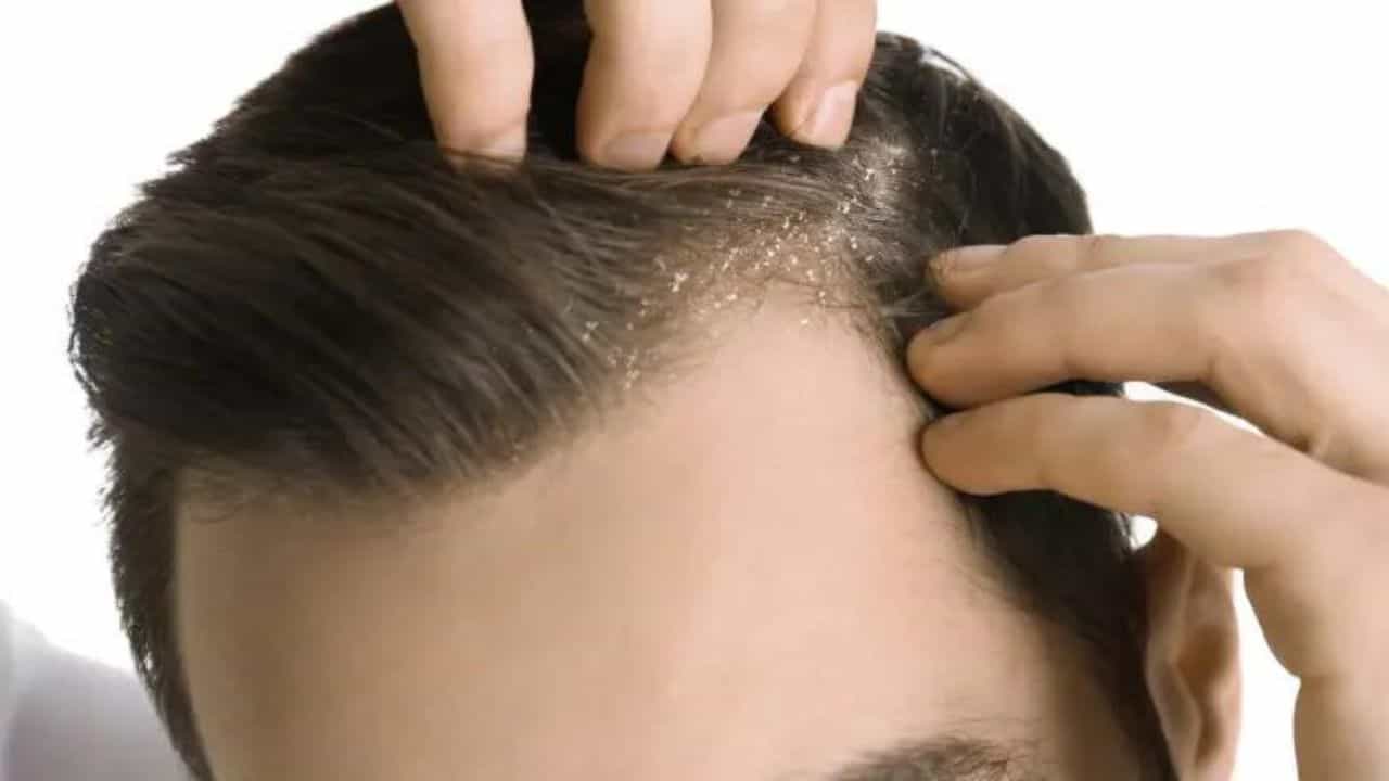 এই গরমে খুশকির সমস্যা বাড়াটা অস্বাভাবিক কিছু নয়। অতিরিক্ত ঘাম, ধুলো, তাপ এবং স্ক্যাল্পে তৈলাক্ত ভাব খুশকির আদর্শ পরিবেশ তৈরি করে। তবে কিছু ঘরোয়া পদ্ধতি এবং নিয়মিত যত্নের মাধ্যমে এই সমস্যা থেকে সহজেই রক্ষা পাওয়া সম্ভব। কী ভাবে তার সঙ্গে লড়াই করবেন? রইল ৭টি টিপস। 