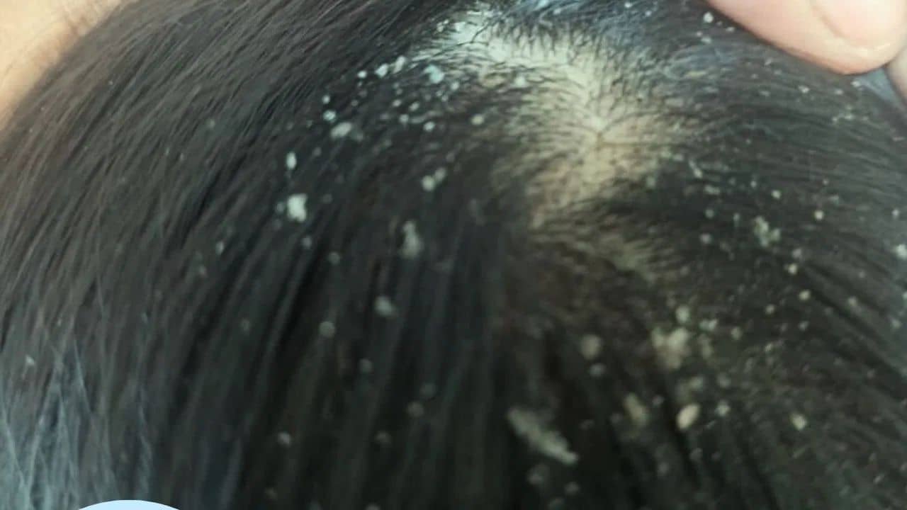 Dandruff Tips: বর্ষা এলেই মাথায় ভরে যায় সাদা সাদা খুশকি? কী ভাবে মুক্তি পাবেন?