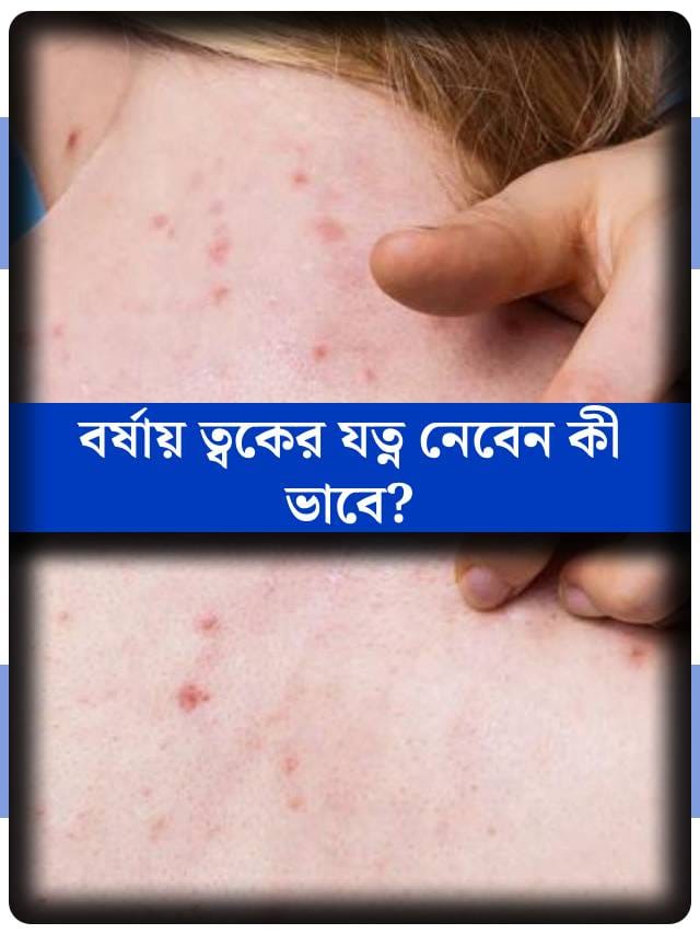 Mogam Rash বর্ষাতেও দেখা দিতে পারে র্যাশ বা চুলকানির সমস্যা! কী করবেন? – TV9Bangla