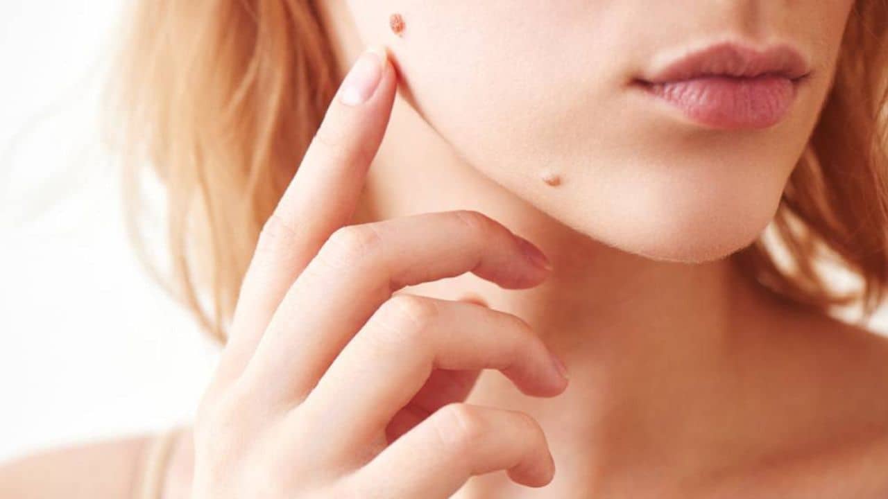 কপালে নাকি গালে, আঁচিল কোথায় থাকা অশুভ?