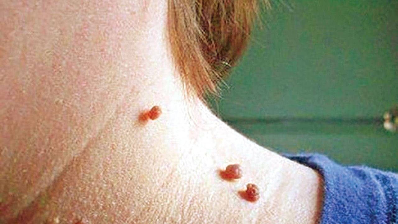 আঁচিল কেন হয়? কী করা উচিত?