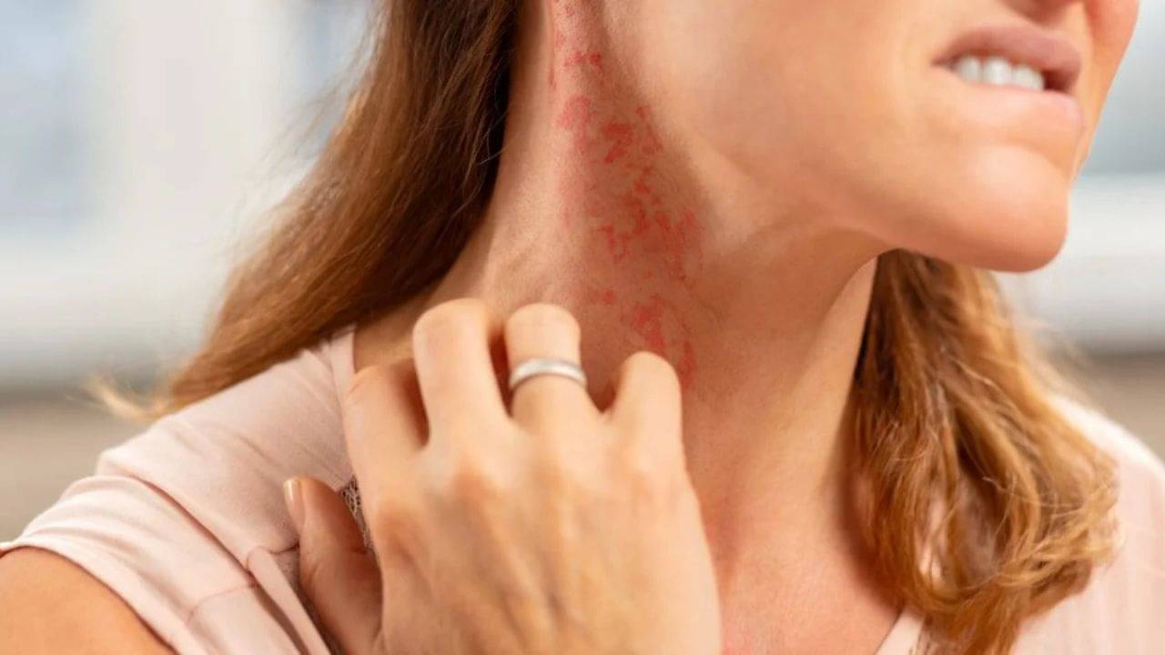 অ্যালার্জি আপনা হতেই সেরে যায়? কতটা ভয়ানক হতে পারে? জানুন বিশ্ব অ্যালার্জি সপ্তাহে