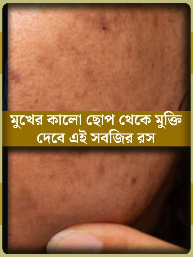 ব্রণর কালো দাগ, মুখের কালচে ছোপ, সব নিমেষে হবে গায়েব! মাখুন এই সবজির রস ব্রণর কালো দাগ, মুখের কালচে ছোপ, সব নিমেষে হবে গায়েব! মাখুন এই সবজির রস