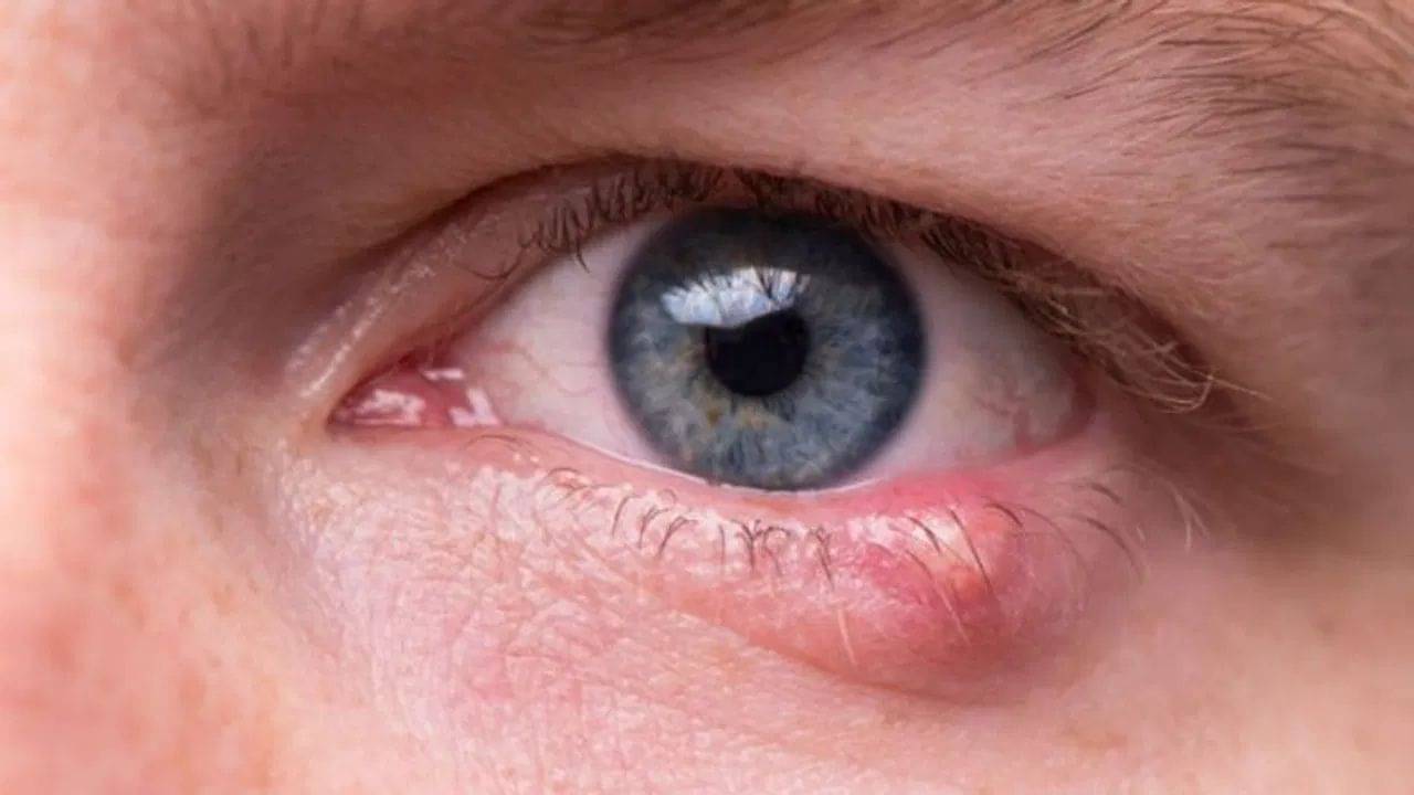 চোখে আঞ্জনি কেন হয়? হলে কী করবেন?